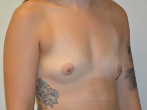 Breast Augmentation Before Patient 4