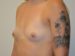 Breast Augmentation Before Patient Thumbnail 2