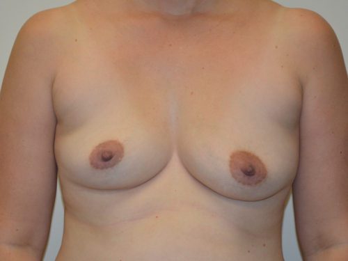 Breast Augmentation Before Patient 1