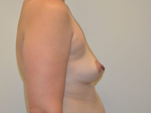 Breast Augmentation Before Patient 3