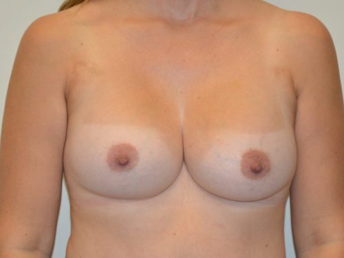 Breast Augmentation After Patient 1