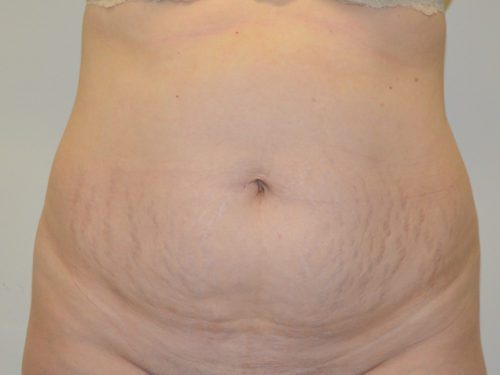 Tummy Tuck Before Patient 1