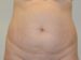 Tummy Tuck Before Patient Thumbnail 1