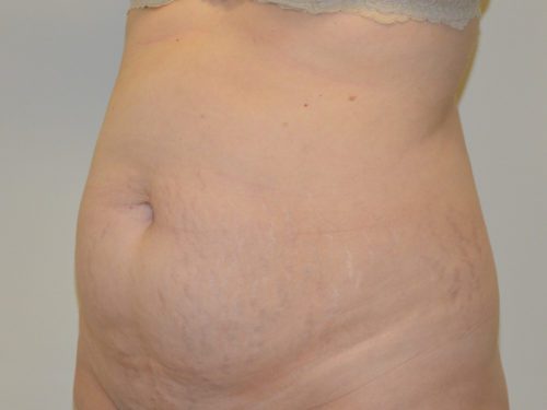 Tummy Tuck Before Patient 2