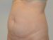 Tummy Tuck Before Patient Thumbnail 2