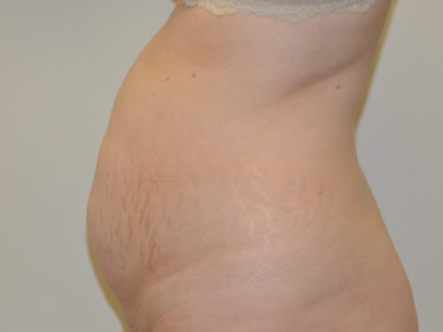 Tummy Tuck Before Patient 3