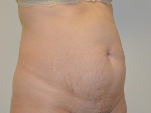 Tummy Tuck Before Patient 4