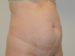 Tummy Tuck Before Patient Thumbnail 4