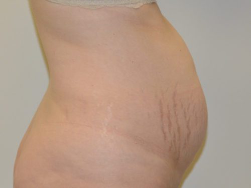 Tummy Tuck Before Patient 5