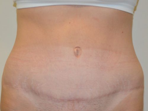 Tummy Tuck After Patient 1