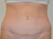 Tummy Tuck After Patient Thumbnail 1