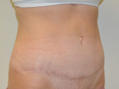 Tummy Tuck After Patient 4