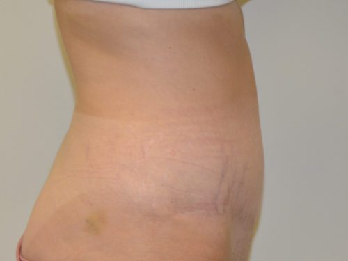 Tummy Tuck After Patient 5