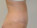 Tummy Tuck After Patient Thumbnail 5