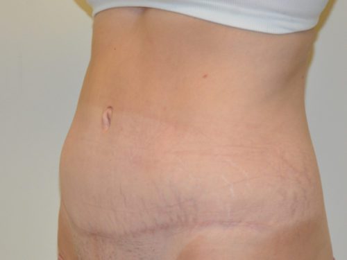 Tummy Tuck After Patient 2