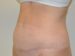 Tummy Tuck After Patient Thumbnail 2