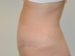 Tummy Tuck After Patient Thumbnail 3