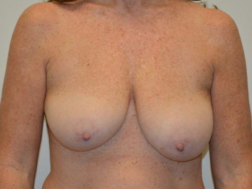 Breast Lift Before Patient 1