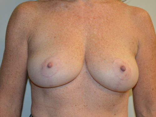 Breast Lift After Patient 1