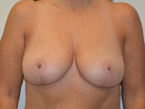 Breast Lift After Patient 1