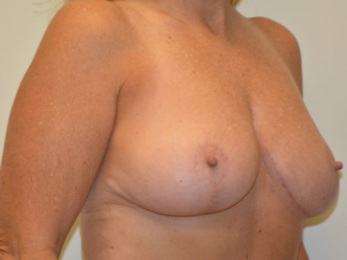 Breast Lift After Patient 2