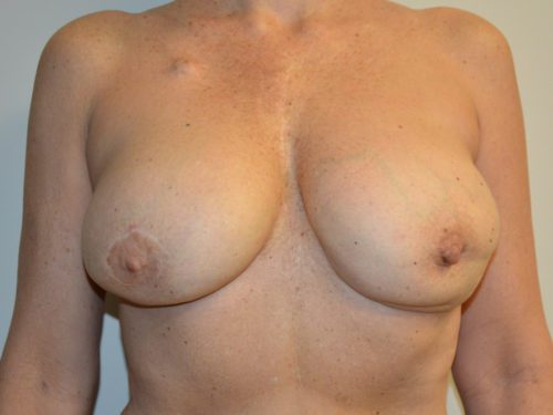 Breast Revision After Patient 1