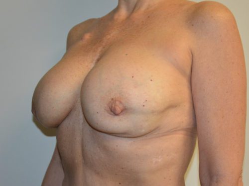 Breast Revision After Patient 2