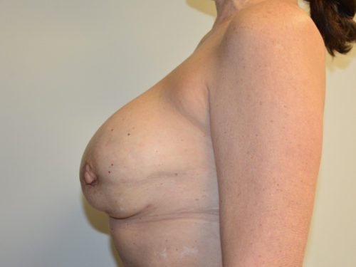 Breast Revision After Patient 3