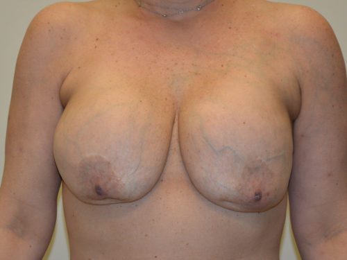 Breast Reconstruction Tissue Expanders Before Patient 1