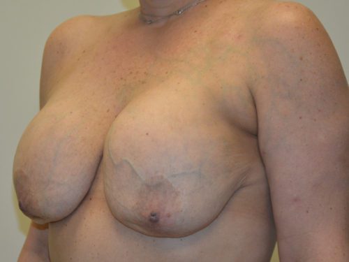 Breast Reconstruction Tissue Expanders Before Patient 4