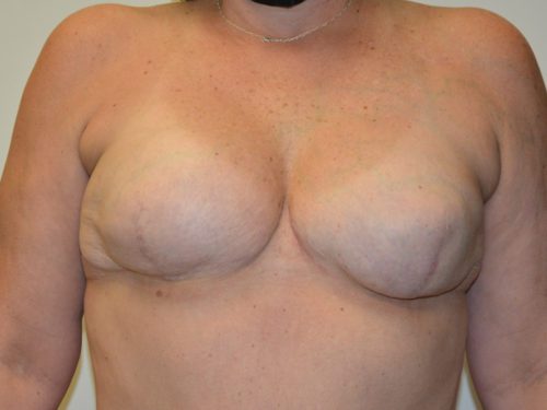 Breast Reconstruction Tissue Expanders After Patient 1