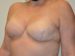 Breast Reconstruction Tissue Expanders After Patient Thumbnail 4