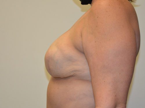 Breast Reconstruction Tissue Expanders After Patient 5