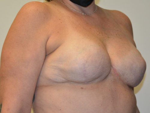 Breast Reconstruction Tissue Expanders After Patient 2