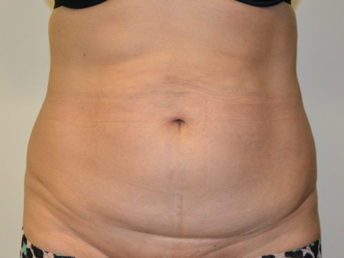 Tummy Tuck Before Patient 1