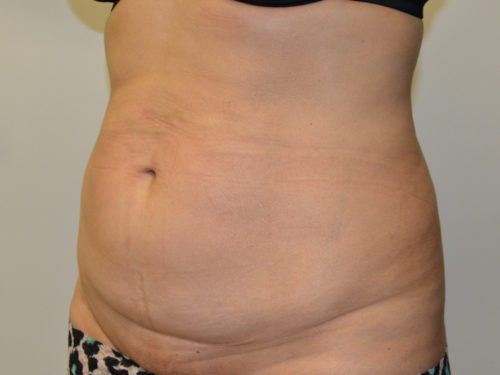 Tummy Tuck Before Patient 2