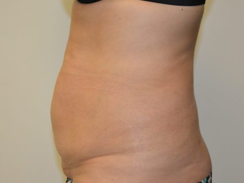 Tummy Tuck Before Patient 3