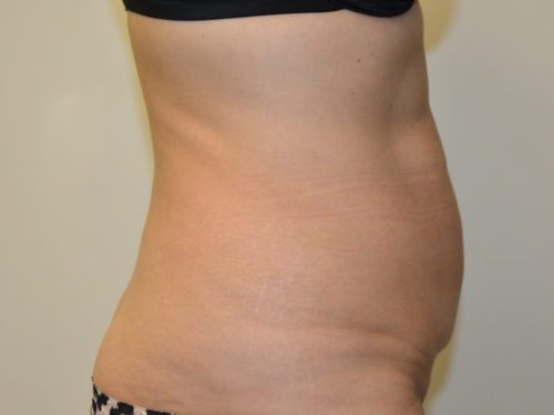 Tummy Tuck Before Patient 5