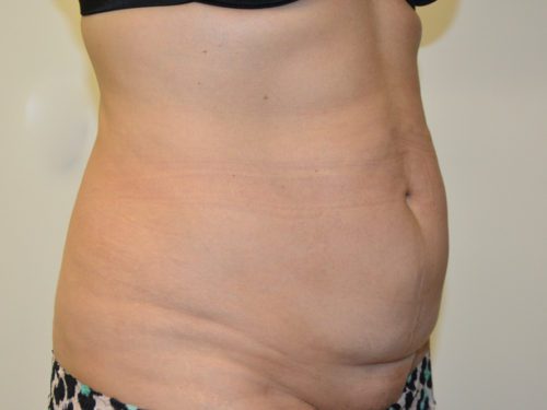 Tummy Tuck Before Patient 4