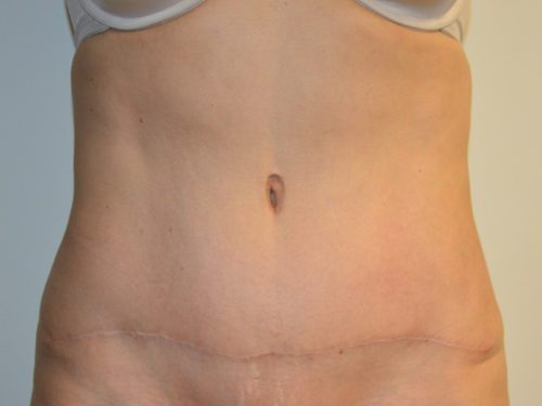 Tummy Tuck After Patient 1