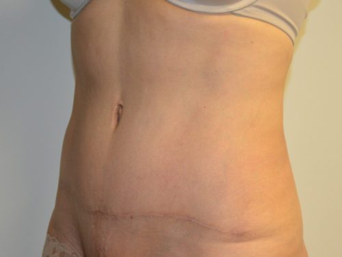 Tummy Tuck After Patient 2