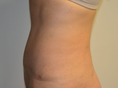 Tummy Tuck After Patient 3