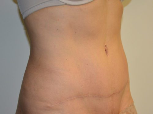 Tummy Tuck After Patient 4