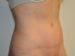 Tummy Tuck After Patient Thumbnail 4