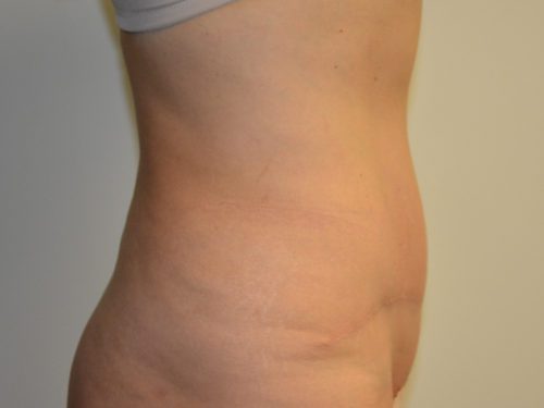 Tummy Tuck After Patient 5