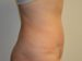 Tummy Tuck After Patient Thumbnail 5