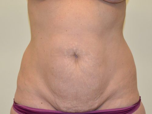 Tummy Tuck Before Patient 1