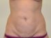 Tummy Tuck Before Patient Thumbnail 1