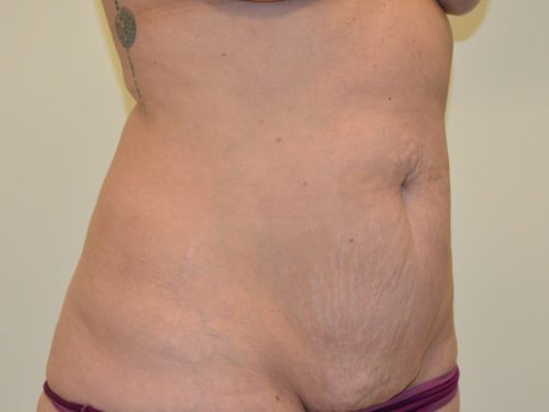 Tummy Tuck Before Patient 4