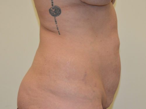 Tummy Tuck Before Patient 5